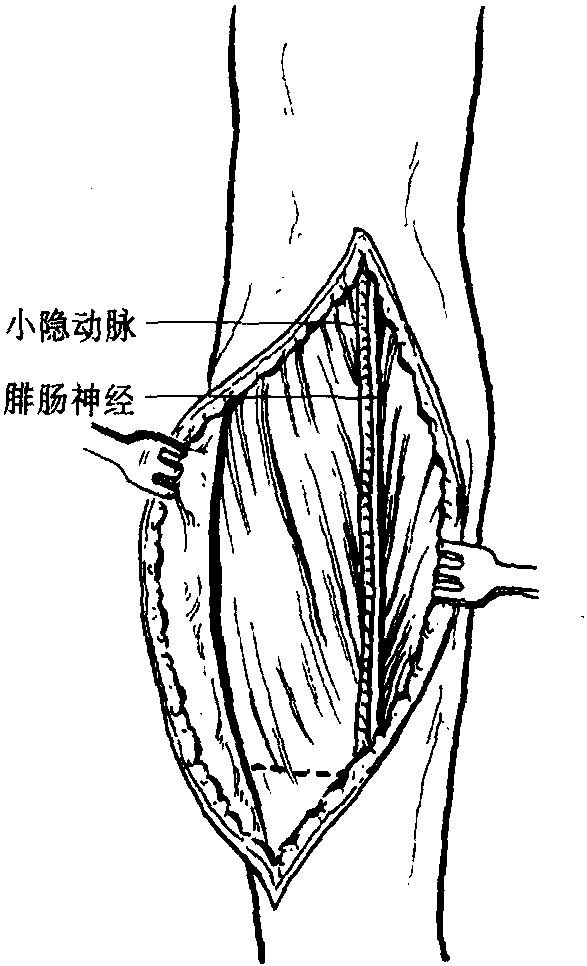 23 腓腸肌肌皮瓣